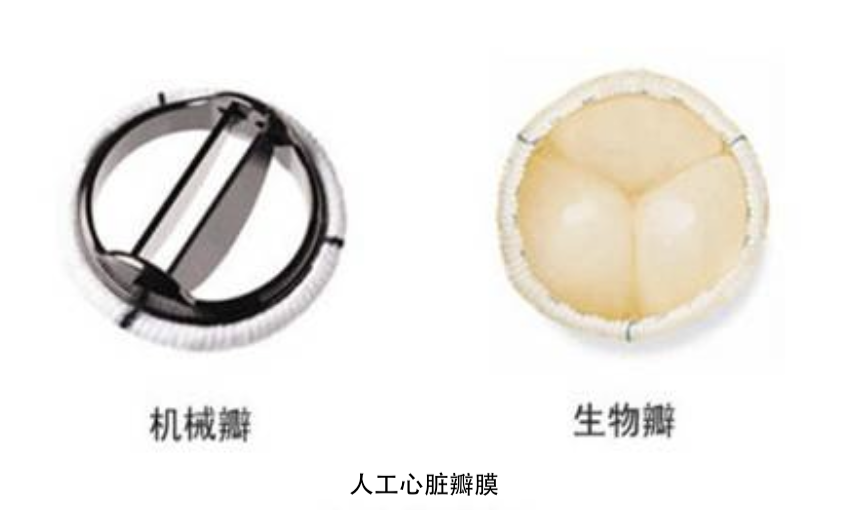 如何选择人工心脏瓣膜？