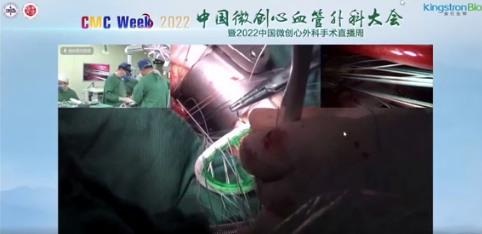 金仕元素力二尖瓣成形环微创植入惊艳亮相中国微创心血管外科大会